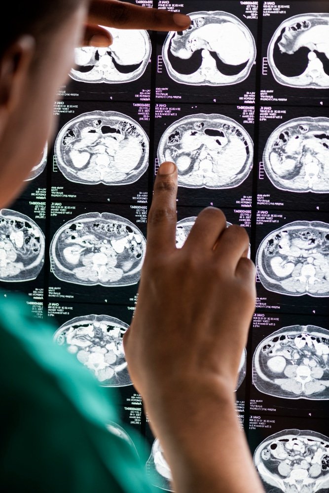 Banco deverá indenizar advogada que teve aneurisma cerebral